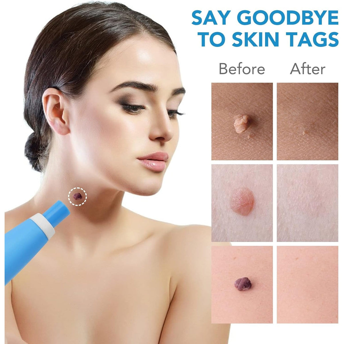 Skin Tag Remover